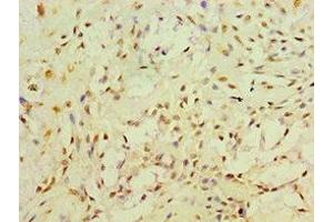 Immunohistochemistry of paraffin-embedded human breast cancer using ABIN7166493 at dilution of 1:100 (Ret Proto-Oncogene antibody  (AA 29-300))