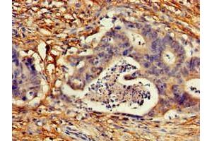 Immunohistochemistry of paraffin-embedded human colon cancer using ABIN7148889 at dilution of 1:100