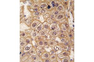 Formalin-fixed and paraffin-embedded human hepatocarcinoma tissue reacted with BAR2 Antibody  (ABIN391397 and ABIN2841401) , which was peroxidase-conjugated to the secondary antibody, followed by DAB staining. (BAR2 antibody  (AA 236-264))