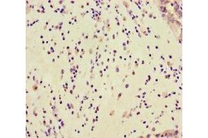 Immunohistochemistry of paraffin-embedded human lung cancer using ABIN7154798 at dilution of 1:100