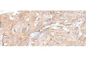 Immunohistochemistry of paraffin-embedded Human esophagus cancer tissue using SNRNP25 Polyclonal Antibody at dilution of 1:65(x200) (SNRNP25 antibody)