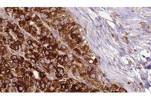 ABIN6272688 at 1/100 staining Human liver cancer tissue by IHC-P. (PTGER1 antibody  (Internal Region))