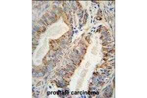AKT2 Monoclonal Antibody (ABIN659024 and ABIN2838047) immunohistochemistry analysis in formalin fixed and paraffin embedded human prostate carcinoma followed by peroxidase conjμgation of the secondary antibody and DAB staining. (AKT2 antibody)