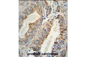 AKT2 Monoclonal Antibody (ABIN659024 and ABIN2838047) immunohistochemistry analysis in formalin fixed and paraffin embedded human prostate carcinoma followed by peroxidase conjμgation of the secondary antibody and DAB staining. (AKT2 antibody)