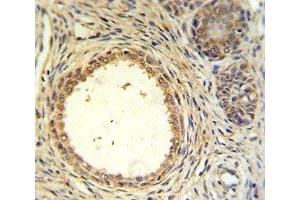 AMH antibody IHC analysis in formalin fixed and paraffin embedded prostate carcinoma. (AMH antibody  (AA 424-451))