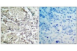 Immunohistochemical analysis of paraffin- embedded human breast carcinoma tissue, using MKK3 (Ab-189) antibody (E021116). (MAP2K3 antibody)