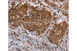 Immunohistochemistry of Human cervical cancer using DUSP8 Polyclonal Antibody at dilution of 1:30