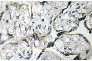 Immunohistochemistry (IHC) analyzes of PAKalpha antibody in paraffin-embedded human breast carcinoma tissue. (PAK1 antibody)