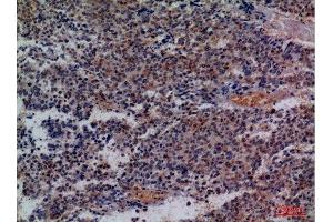 Immunohistochemistry (IHC) analysis of paraffin-embedded Human Lung Cancer, antibody was diluted at 1:100.