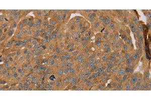 Immunohistochemistry of paraffin-embedded Human breast cancer tissue using PARP11 Polyclonal Antibody at dilution 1:30 (PARP11 antibody)