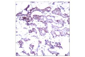 Immunohistochemical analysis of paraffin- embedded human breast carcinoma tissue using Elk-1 (Ab-389) antibody (E021037). (ELK1 antibody)