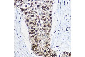 Immunohistochemistry of paraffin-embedded human lung cancer using SM Rabbit pAb (ABIN6132562, ABIN6148098, ABIN6148099 and ABIN6214424) at dilution of 1:100 (40x lens). (SMARCA1 antibody  (AA 1-200))