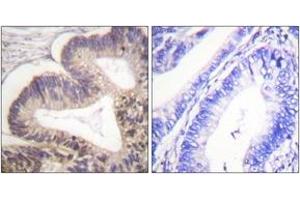 Immunohistochemistry analysis of paraffin-embedded human colon carcinoma, using PAK2 (Phospho-Ser20) Antibody. (PAK2 antibody  (pSer20))