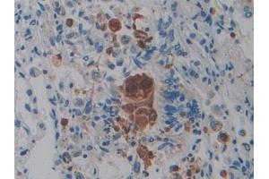 Detection of PTPRQ in Human Lung cancer Tissue using Polyclonal Antibody to Protein Tyrosine Phosphatase Receptor Type Q (PTPRQ) (PTPRQ antibody  (AA 36-294))