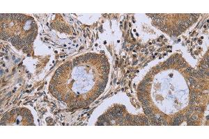 Immunohistochemistry of paraffin-embedded Human colon cancer using FKBP8 Polyclonal Antibody at dilution of 1:50 (FKBP8 antibody)