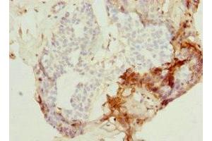 Immunohistochemistry of paraffin-embedded human breast cancer using ABIN7162990 at dilution of 1:100 (PEX7 antibody  (AA 1-240))