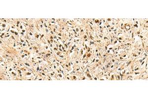 Immunohistochemistry of paraffin-embedded Human prost ate cancer tissue using PSMA3 Polyclonal Antibody at dilution of 1:50(x200)