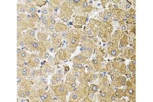 Immunohistochemistry of paraffin-embedded Human liver damage using CEP164 Polyclonal Antibody (CEP164 antibody)