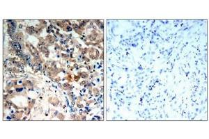 Immunohistochemical analysis of paraffin-embedded human lung carcinoma tissue, using AMPK-alpha,1/AMPK-alpha,2(Phospho-Thr174/Thr172) Antibody. (AMPK alpha antibody  (pThr172, pThr183))