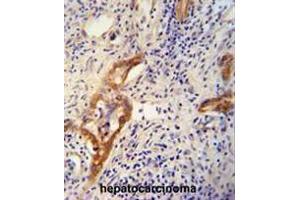 CLPX antibody (C-term) immunohistochemistry analysis in formalin fixed and paraffin embedded human hepatocarcinoma followed by peroxidase conjugation of the secondary antibody and DAB staining. (CLPX antibody  (C-Term))