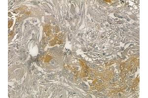 ABIN6262005 and ABIN6273249 at 1/100 staining human lung adenocarcinoma by IHC-P.