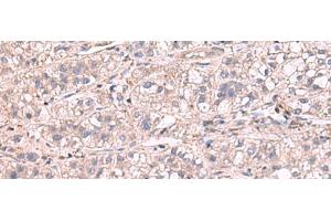 Immunohistochemistry of paraffin-embedded Human liver cancer tissue using KCNIP1 Polyclonal Antibody at dilution of 1:60(x200) (KCNIP1 antibody)