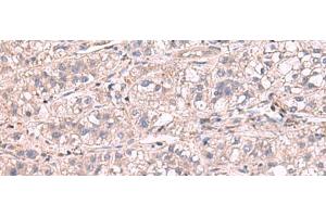 Immunohistochemistry of paraffin-embedded Human liver cancer tissue using KCNIP1 Polyclonal Antibody at dilution of 1:60(x200)
