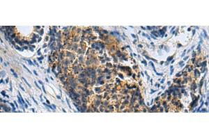 Immunohistochemistry of paraffin-embedded Human prost ate cancer tissue using PLIN4 Polyclonal Antibody at dilution of 1:50(x200) (PLIN4 antibody)