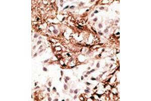 Immunohistochemical staining (Formalin-fixed paraffin-embedded sections) of human breast cancer tissue with MAP1LC3C polyclonal antibody  at 1:50-100 dilution.
