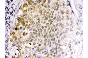 Anti- EME1 Picoband antibody,IHC(P) IHC(P): Human Lung Cancer Tissue