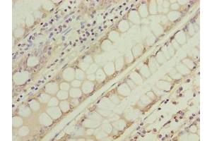 Immunohistochemistry of paraffin-embedded human colon cancer using ABIN7166731 at dilution of 1:100 (NSUN7 antibody  (AA 1-300))