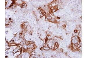 IHC-P Image Immunohistochemical analysis of paraffin-embedded CA922 xenograft, using RPSA, antibody at 1:500 dilution. (RPSA/Laminin Receptor antibody)