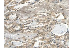 Detection of Cys-C in Human Thyroid cancer Tissue using Monoclonal Antibody to Cystatin C (Cys-C) (CST3 antibody  (AA 27-146))