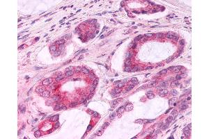 Anti-CCR3 antibody IHC of human Prostate, Carcinoma. (CCR3 antibody  (C-Term))