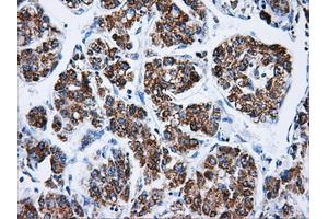 Immunohistochemical staining of paraffin-embedded Carcinoma of liver tissue using anti-ATP5Bmouse monoclonal antibody.
