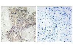 Immunohistochemistry analysis of paraffin-embedded human liver carcinoma tissue using B3GALTL antibody. (B3GALTL antibody  (C-Term))