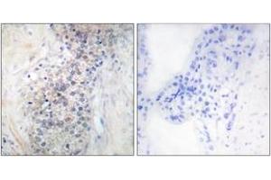 Immunohistochemistry analysis of paraffin-embedded human prostate carcinoma tissue, using LRAT Antibody. (LRAT antibody  (AA 111-160))