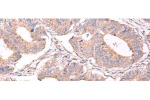 Immunohistochemistry of paraffin-embedded Human colorectal cancer tissue using ESM1 Polyclonal Antibody at dilution of 1:50(x200) (ESM1 antibody)