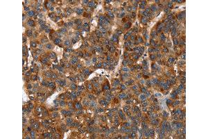 Immunohistochemistry of Human lung cancer using CACNB2 Polyclonal Antibody at dilution of 1:30 (CACNB2 antibody)