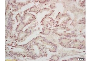Formalin-fixed and paraffin embedded human gastric carcinoma labeled with Rabbit Anti Annexin A13 Polyclonal Antibody, Unconjugated (ABIN1714416) at 1:200 followed by conjugation to the secondary antibody and DAB staining (CRY1 antibody)
