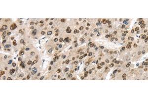 Immunohistochemistry of paraffin-embedded Human liver cancer using TUSC5 Polyclonal Antibody at dilution of 1/40 (TUSC5 antibody)