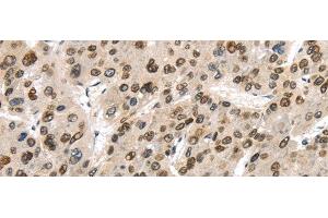 Immunohistochemistry of paraffin-embedded Human liver cancer using TUSC5 Polyclonal Antibody at dilution of 1/40