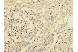 Immunohistochemistry of paraffin-embedded human pancreatic cancer using ABIN7153123 at dilution of 1:100 (FOSL2 antibody  (AA 1-326))