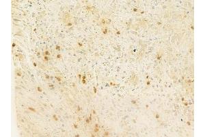 ABIN6261778 and ABIN6278766 at 1/100 staining human prostate carcinoma by IHC-P. (ZFPM2 antibody  (C-Term))