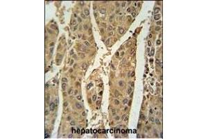 PRDX6 Antibody (Center) (ABIN650765 and ABIN2839536) immunohistochemistry analysis in formalin fixed and paraffin embedded human hepatocarcinoma followed by peroxidase conjugation of the secondary antibody and DAB staining. (Peroxiredoxin 6 antibody  (AA 103-132))