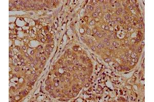 IHC image of ABIN7163597 diluted at 1:300 and staining in paraffin-embedded human liver cancer performed on a Leica BondTM system. (PAFAH2 antibody  (AA 1-206))