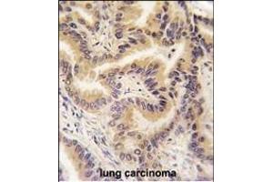 Formalin-fixed and paraffin-embedded human lung carcinoma tissue reacted with RAF1 Antibody   , which was peroxidase-conjugated to the secondary antibody, followed by DAB staining. (RAF1 antibody  (AA 211-240))