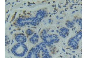 DAB staining on IHC-P; Samples: Human Breast cancer Tissue (GSK3 alpha antibody  (AA 115-409))