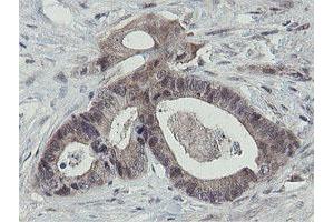 Immunohistochemical staining of paraffin-embedded Adenocarcinoma of Human colon tissue using anti-OTUB1 mouse monoclonal antibody. (OTUB1 antibody)