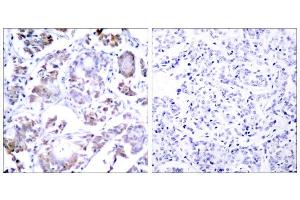 Immunohistochemical analysis of paraffin-embedded human breast carcinoma tissue, using NF-κB p65 (Ab-254) antibody (E021010). (NF-kB p65 antibody)